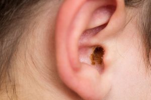 Gross ear Wax